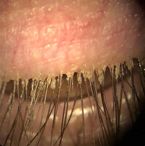 Eyelash Mites / Demodex Blepharitis: Causes, Symptoms, and Treatments ...