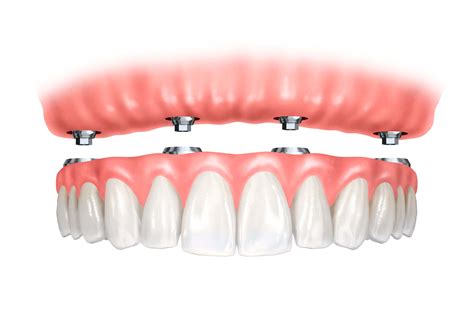 Implant Retained Dentures