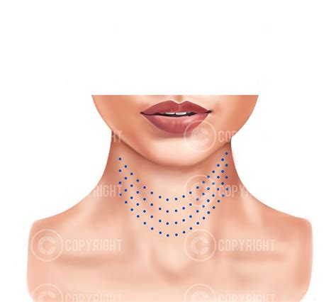 Image result for Botox Injection Patterns