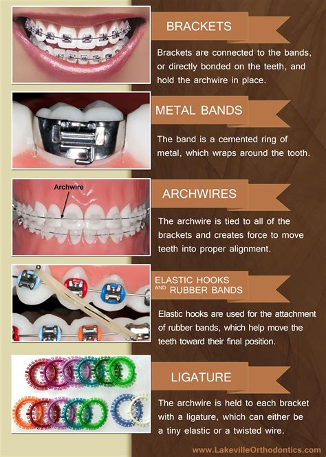 5 parts of braces | Dental braces, Braces tips, Getting braces