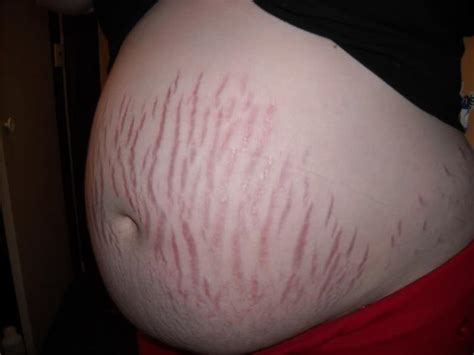 这些孕妇最容易长妊娠纹，孕妇该如何祛除妊娠纹呢？ - 知乎