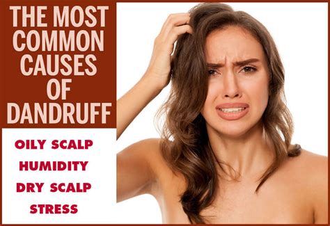 Main Causes Of Dandruff & How To Avoid Them | Femina.in