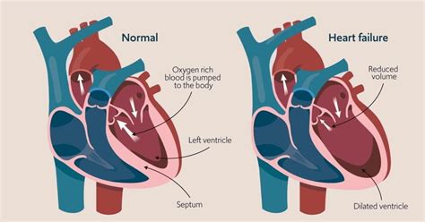 Body Fluids and Circulation Chapter Notes | Biology Class 11 - NEET PDF ...