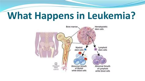 Leukemia and its types presentation 1 | PPTX