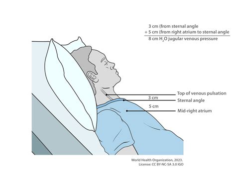 Internal Jugular Measurement at Cody Osborne blog
