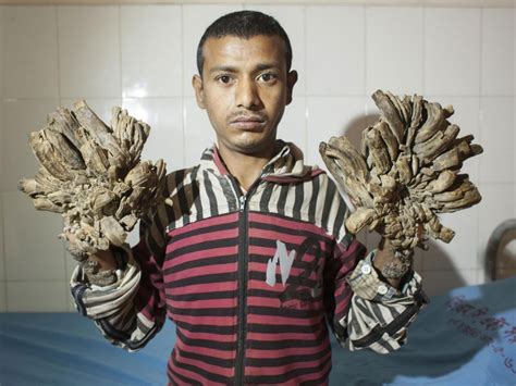 Bangladeshi ‘Tree Man’ wants arms amputated to relieve pain caused by a ...