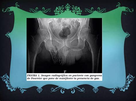 Síndrome de fournier o gangrena perineal | PPT