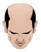 Top Hair Transplant in Mumbai | Hair Transplant in Mumbai