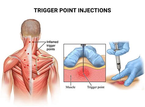 Trigger Point Injections 的图像结果