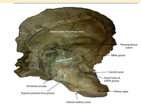 Image result for Temporal Bone Mastoid Process