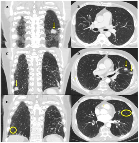 Durable Response to Atezolizumab in Extensive-Stage Small-Cell Lung ...