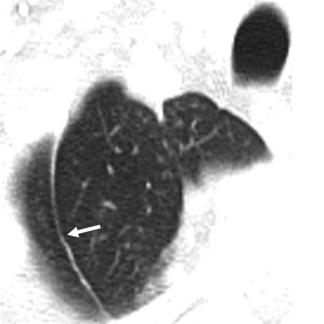 Migrating Azygos Vein and Vanishing Azygos Lobe: Mdct Findings | AJR