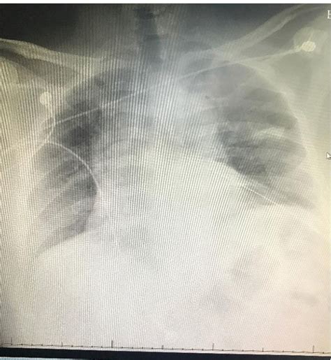 Image result for Left Thoracotomy