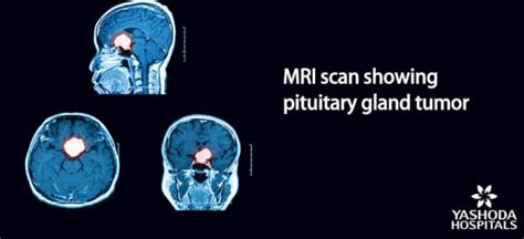 The Role of Imaging and Advanced Diagnostics in Pituitary Tumor Surgery ...