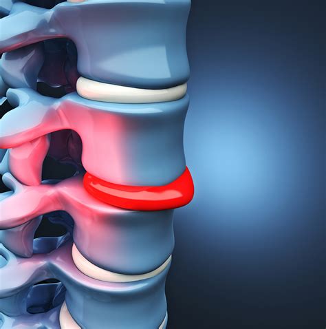 Hernia Discal: Qué Es, Síntomas Y Tratamiento. – YOFR