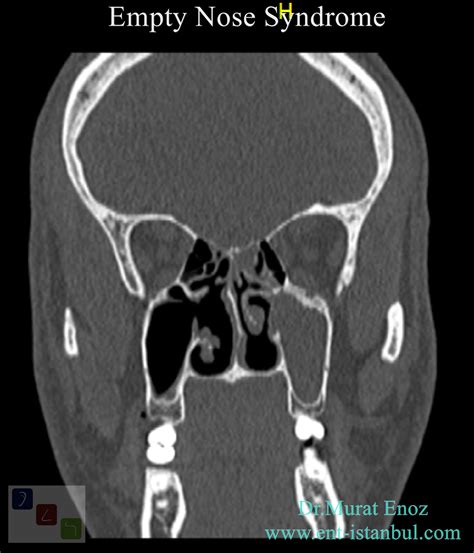 Cool, Small, Dry Turbinate: Empty Nose Syndrome