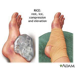Ankle Sprain - Care Guide