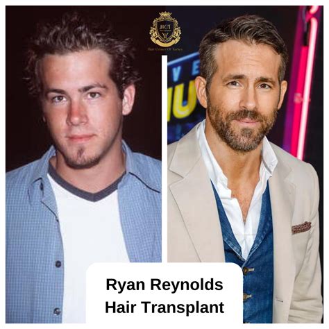 Ryan Reynolds Hair Transplant | Hair Center of Turkey Health Center