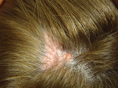 Autosomal dominant transmission of nevus sebaceous of Jadassohn