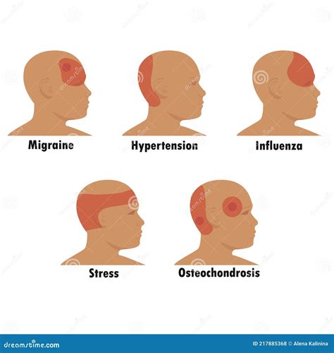 Types of Headaches. Schematic Representation of Foci of Headache in ...