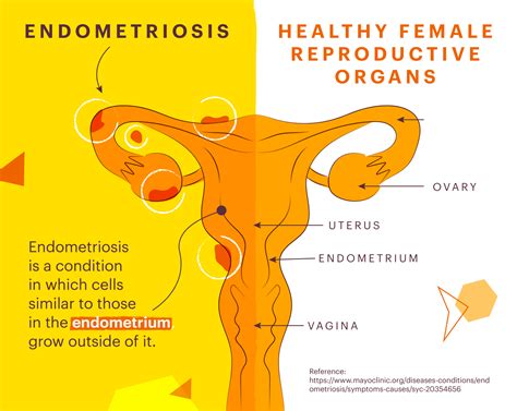 Endometriosis: ignoring the pain | Onyx Health