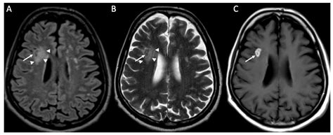 Neuroimaging of the Most Common Meningitis and Encephalitis of Adults: A Narrative Review