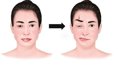 Hemifacial Spasm - Dr Vivek Agrawal