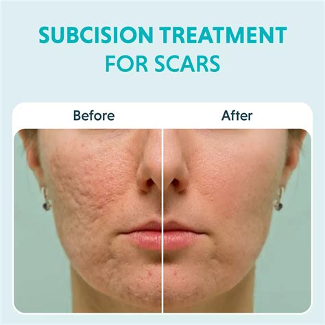 Rolling Scars Treatment: Cost, Procedure, Results & Prevention Tips
