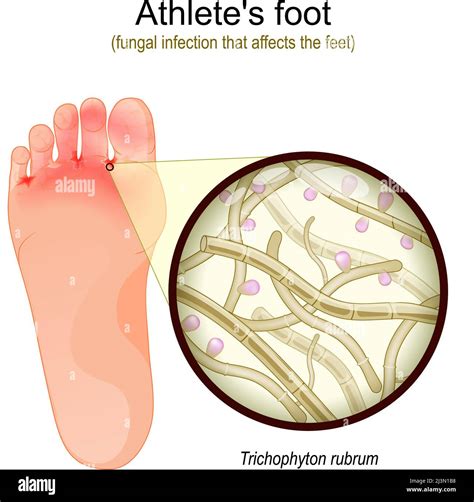 Athlete S Foot