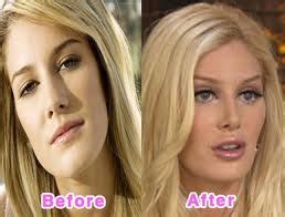 Plastic Surgery Disasters 的图像结果