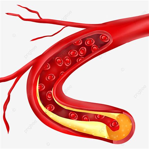 Blood Vessels Clipart PNG Images, Blood Vessel Blockage Cholesterol In ...