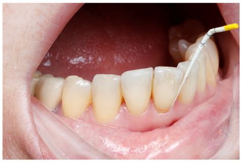 SmartGel OV: A Natural Origanum vulgare-Based Adjunct for Periodontitis ...