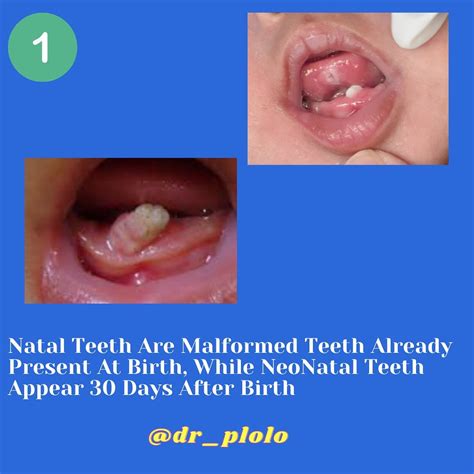 Dr. Patrick S. Lolo 🇭🇹 Children Dentistry | 🦷What Are Natal & Neonatal ...