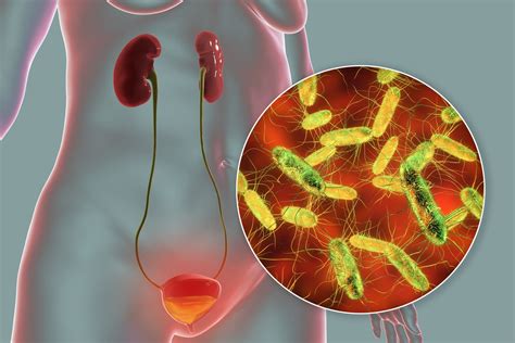 Bacteriuria: Tất Tần Tật Thông Tin, Chẩn Đoán và Điều Trị