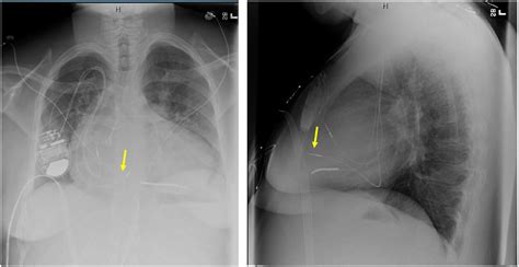 Right ventricular cardiac resynchronization therapy in patients with ...