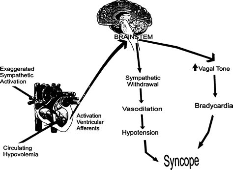 Syncope, Vasovagal; Syncope, Neurocardiogenic; Syncope, Neurogenic ...