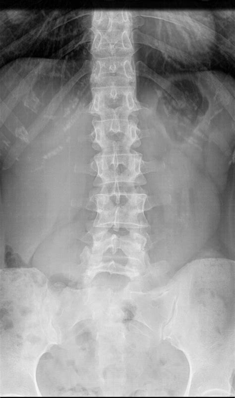 Left low back pain : r/Sciatica