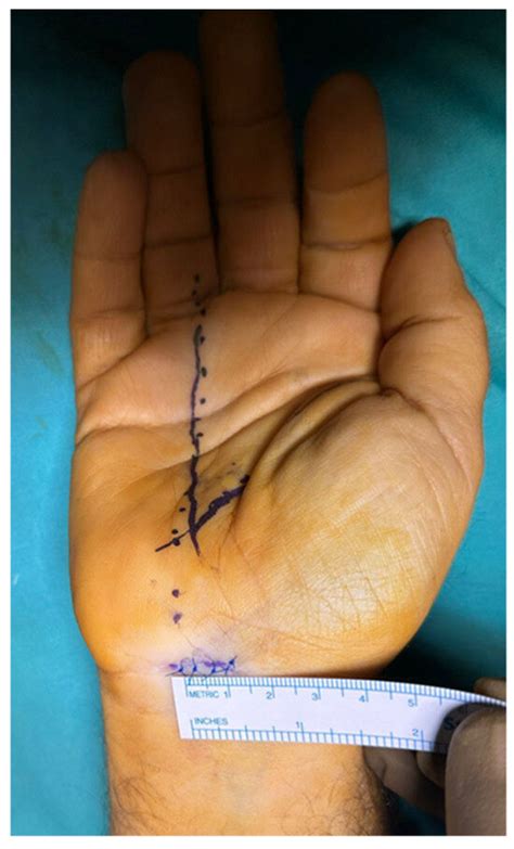 Directly Visualized Carpal Tunnel Release via a Proximal Mini ...