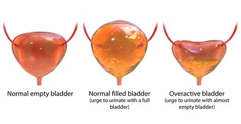 Image result for Bladder Explode