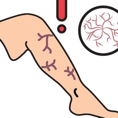 Venous Ulcers Explained: Causes, Early Warning Signs and When Treatment ...