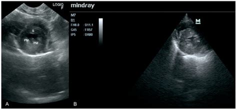 Focused Cardiac Ultrasound Examination as a Tool for Diagnosis of ...