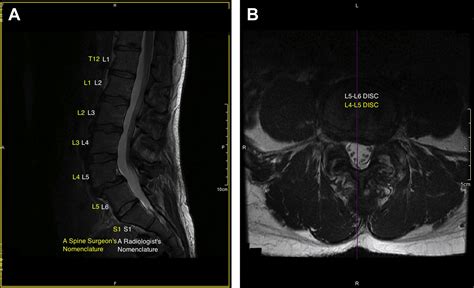 Lumbosacral Transitional Segments - Physical Medicine and ...