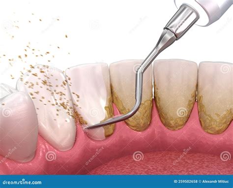 Oral Hygiene: Scaling and Root Planing Conventional Periodontal Therapy. Medically Accurate 3D ...