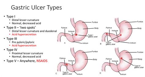 Gastric Ulcer Types