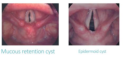STRUCTURAL DISORDERS of the vocal cords.pptx
