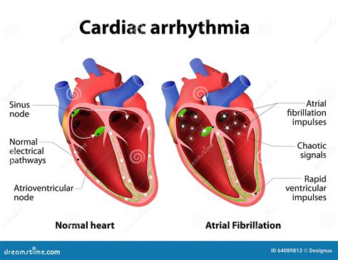 Arrhythmia Cartoons, Illustrations & Vector Stock Images - 3365 ...