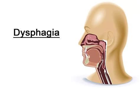 Pharyngeal electrical stimulation may help improve neurogenic dysphagia