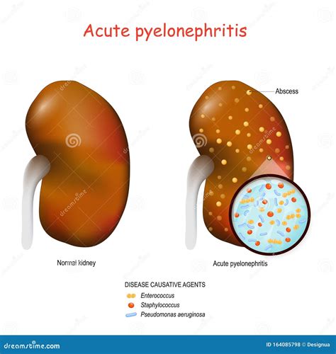 Acute pyelonephritis stock vector. Illustration of nephritis - 164085798