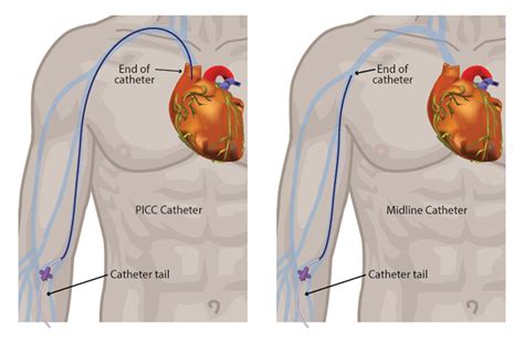 How To Draw Venous Blood Gas From Picc Line