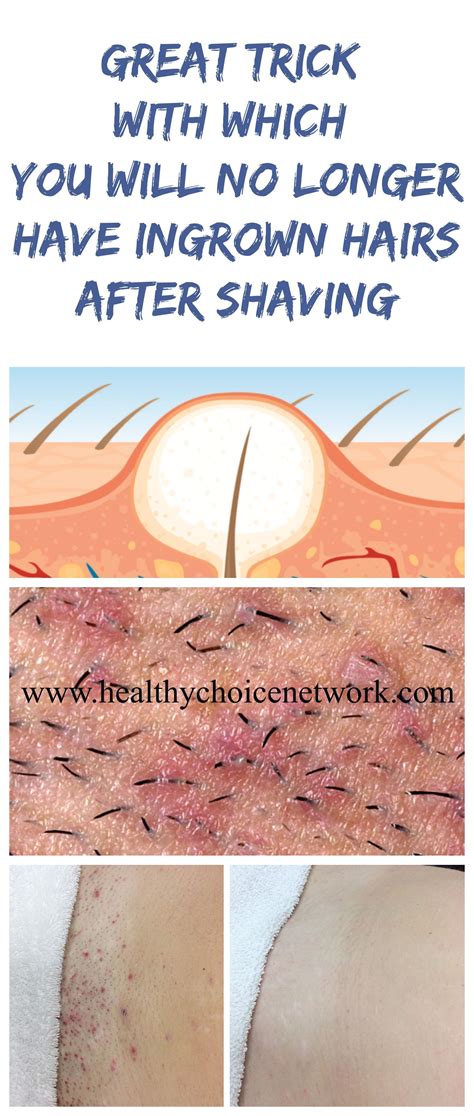How To Treat Ingrown Hair Cyst On Armpit at John Halliburton blog
